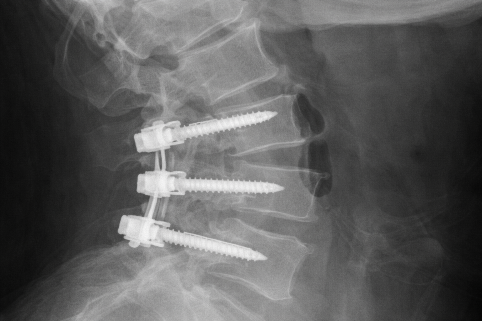 Artrodese — correção de deformidades e fraturas da coluna